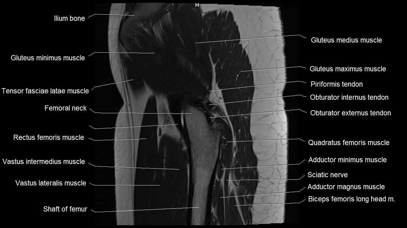 Hip sagittal cross sectional anatomy image 13.webp